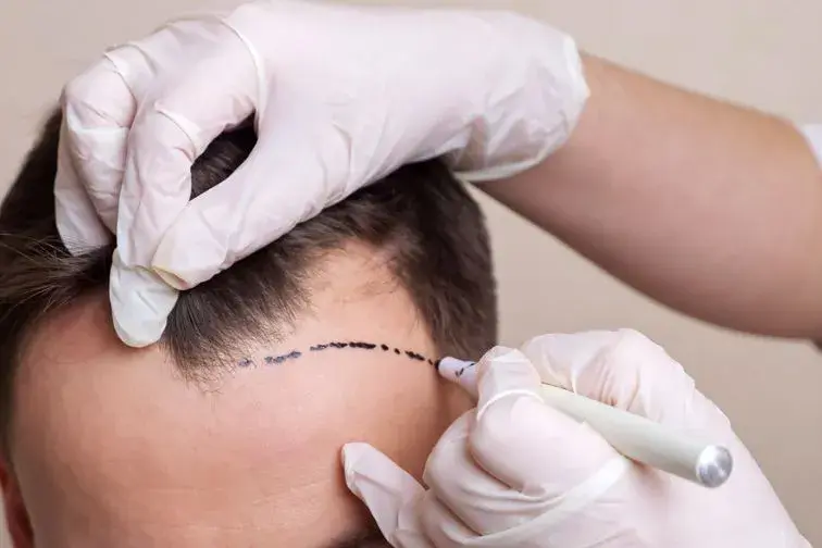 Hairline Restoration Near Me: A Complete Guide to Solutions in 2025